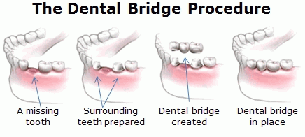 Dentists | Bridges | Marion IL